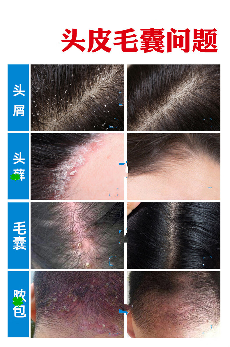 诗莱格头皮毛囊痘痘洗发水头部头皮屑螨虫头上长痘痘痒 360ml【三瓶