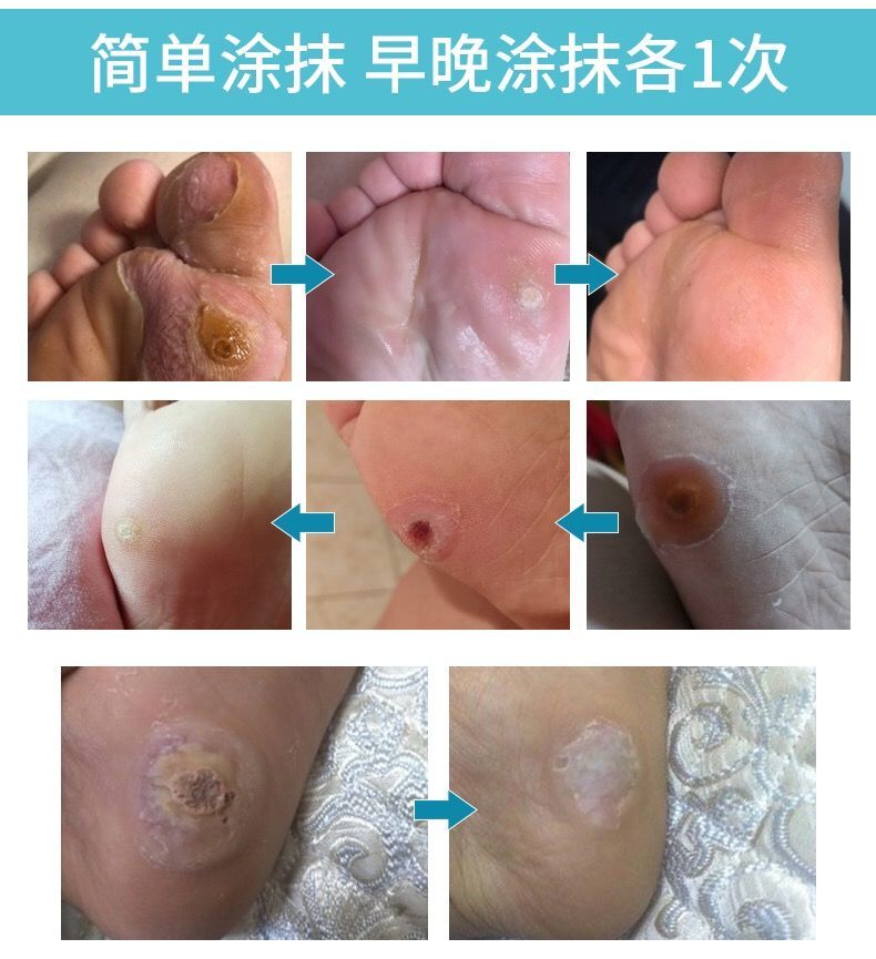 官网鸡尤平成膜液荣晟膏贴脚趾手足部去灵鸡疣平1瓶装