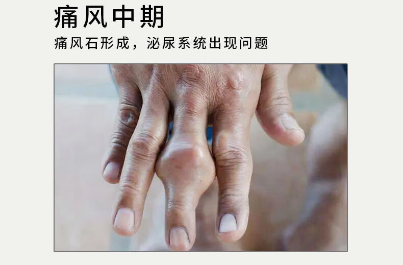 囍成双妙丹堂 痛风贴新版治膝盖手脚指关节肿胀疼专用痛风止痛克星 1