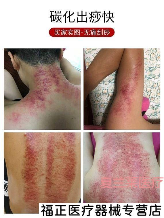 肩颈按摩器斜方肌富贵包消除神器擀筋棒美容院刮痧家用经络疏通仪a16