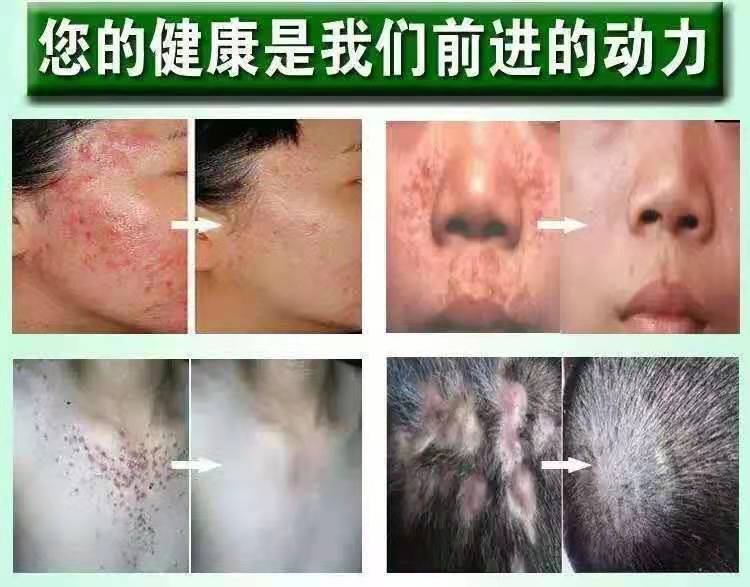 毛囊炎专用头皮部脓包痤疮私处胸背部脸部药膏三盒送同款硫磺皂一块