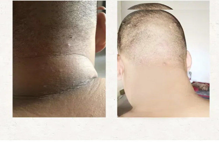 黑棘皮病膏【京推榜单】黑棘皮病膏 黑色素黑棘皮关节膝盖手肘去嘿