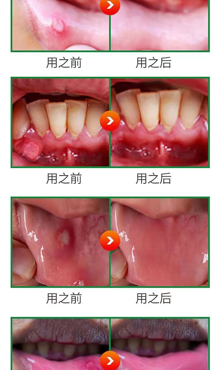 【疼痛难忍】口腔溃疡细菌感染口舌生疮异味牙龈肿痛舌头起泡上火烂嘴