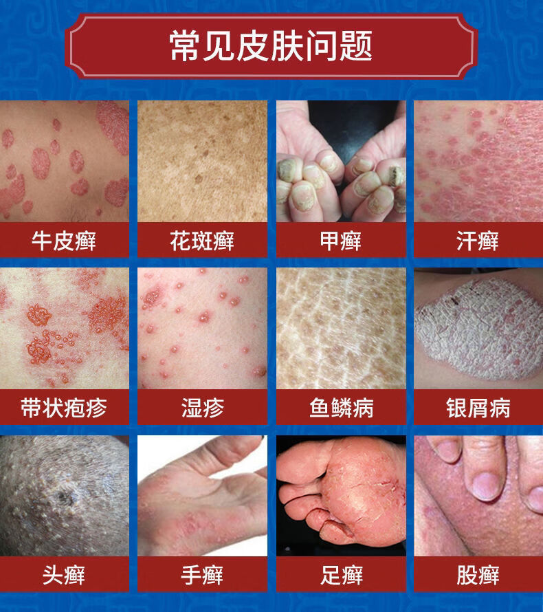 克洛芬草本抑菌膏克洛分芬软膏膏福协堂陕一手芙乐肌草本乳膏肤乐芙