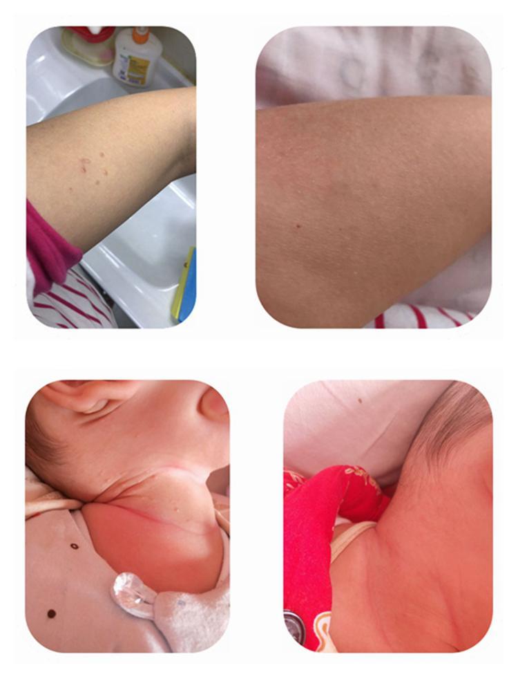 扁平尤尖锐湿疣丝状尤寻常尤疣肉粒刺猴子搭咪喹1莫特乳膏氟脲尿嘧瘊