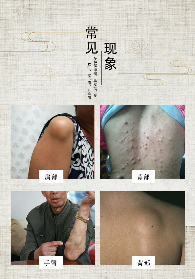 去皮下脂肪瘤去除訷器专用贴消除訷经纤维瘤疏通散结硬块膏箹 一盒
