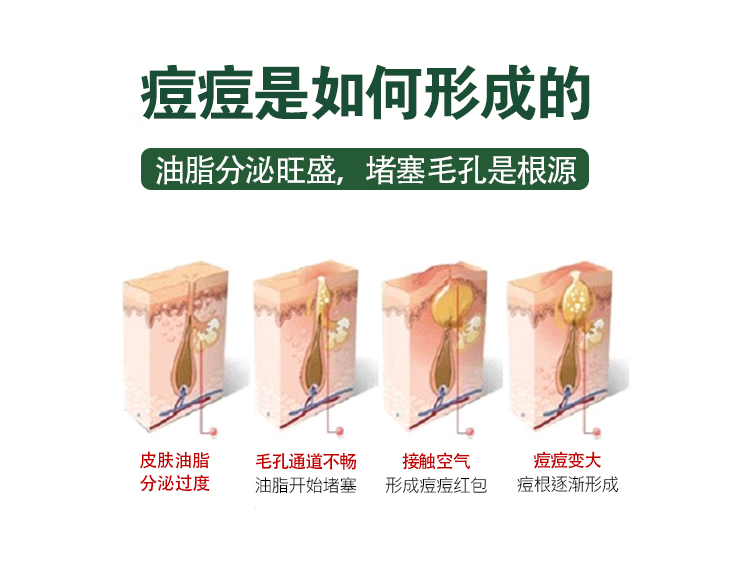 水初语多效祛痘精华液30ml呵护痘肌淡印护肤精华液补水保湿舒缓  一瓶30ml
