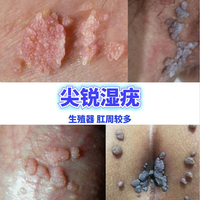 快速去除丝l状l疣扁平i疣寻常i疣尖l锐l疣痦子瘊i子凸痣肉粒肉i刺跖i