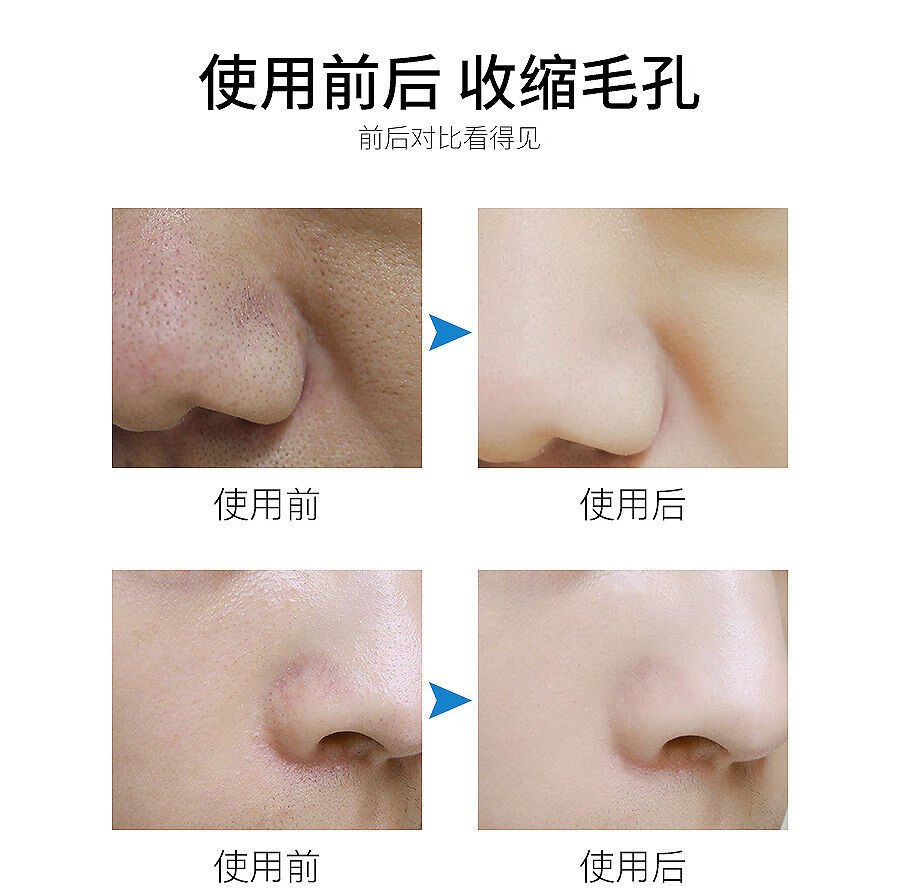 收缩毛孔面部精华液收缩水修复毛孔粗大去黑头粉刺