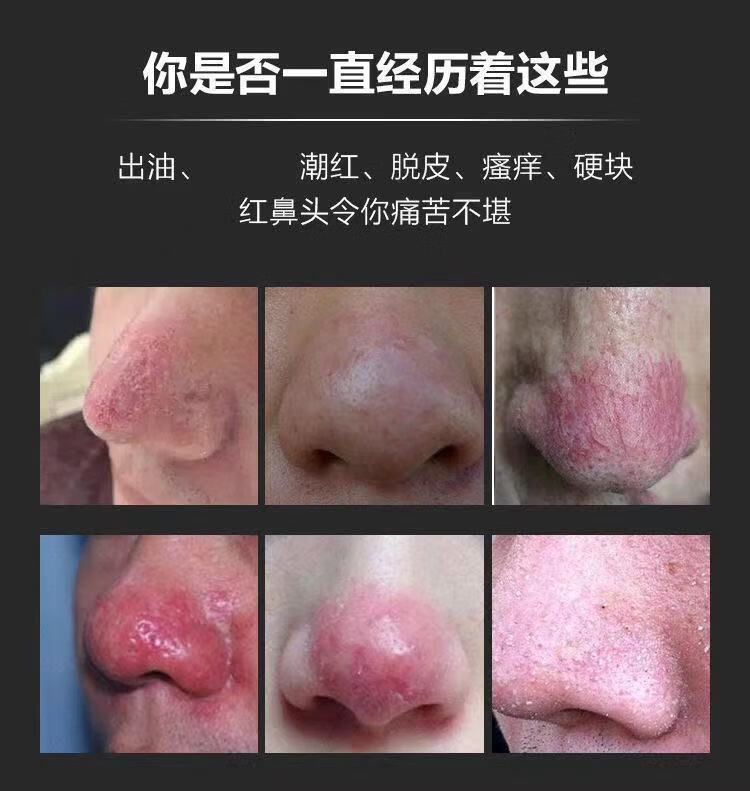 去酒糟鼻专用疗液修复红鼻子治草莓鼻毛孔粗i大粉刺螨克星除专用薬