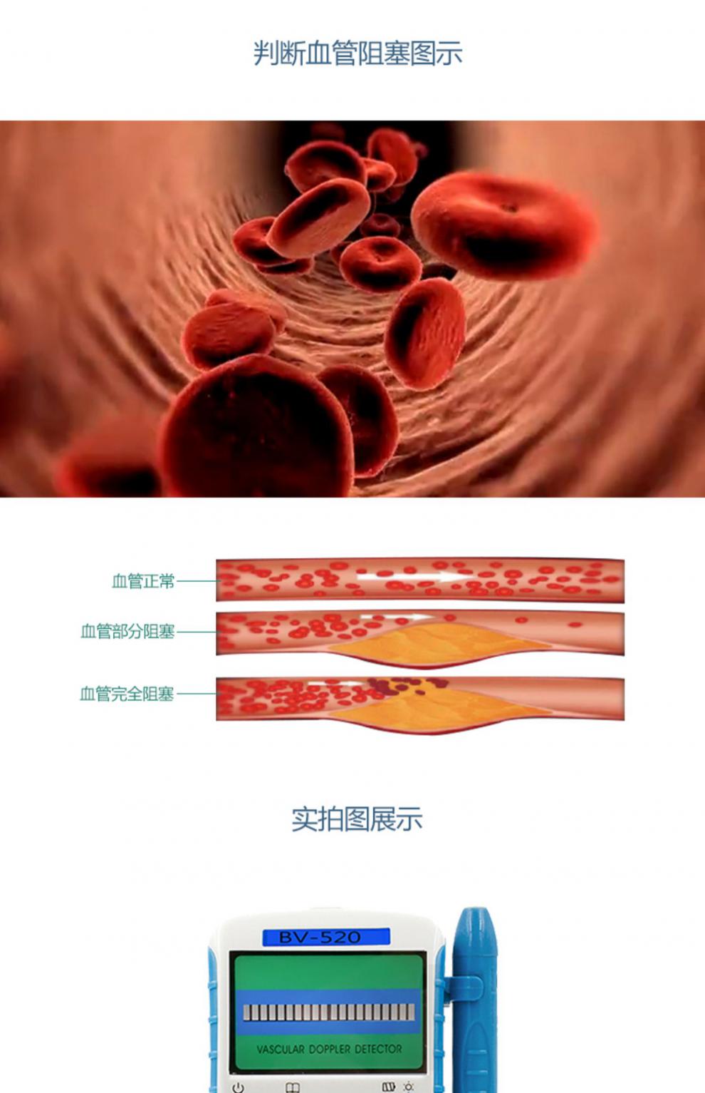 超声多普勒外周血管血流速度检测观察仪动静脉位置狭窄阻塞弹性bv520