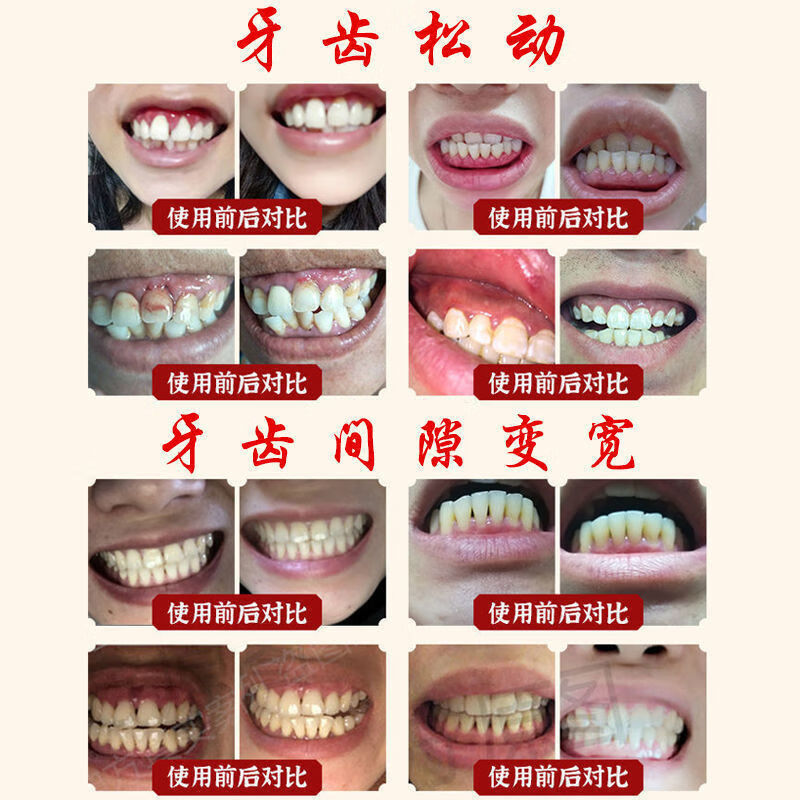 牙縫當天閉合冶牙縫寬大牙齦萎縮修復牙膏牙根外露吃飯塞牙膏5盒週期