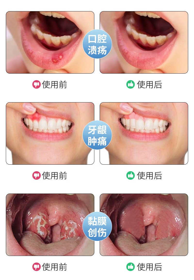 修正口腔溃疡烂舌头口疮咽喉牙龈红肿出血上火起泡痛喷剂1瓶30ml