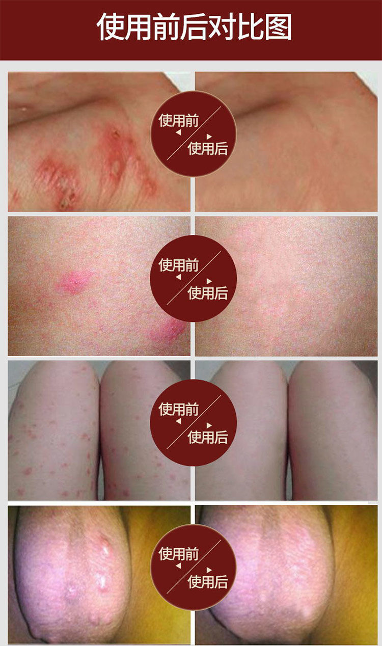 硫磺软膏疥i疮膏去疥i疮结节止痒瘙痒虱疥疥虫阴虱阴囊湿ii疹 买三 二