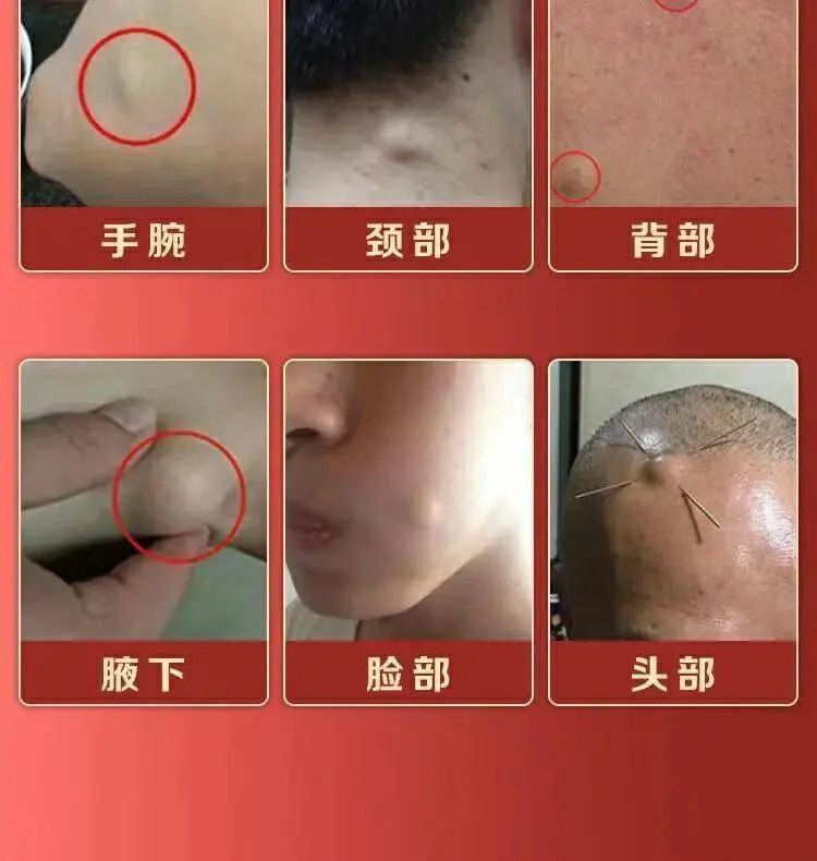 百年秘方脂肪瘤克星专消皮下多发性脂肪瘤硬块肿块去粉瘤囊肿买三二全