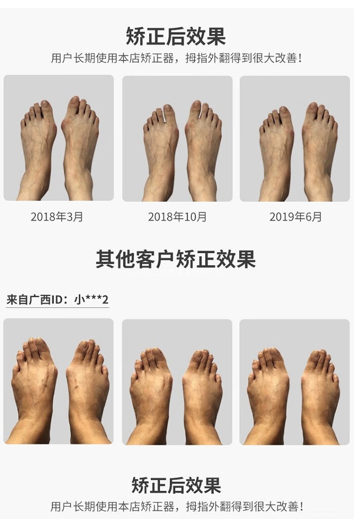 拇指外翻大脚骨器带脚趾分趾器纠正袜可穿鞋男女兼用一对均码
