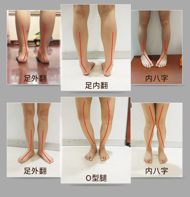 ox型腿和正常腿照片图片