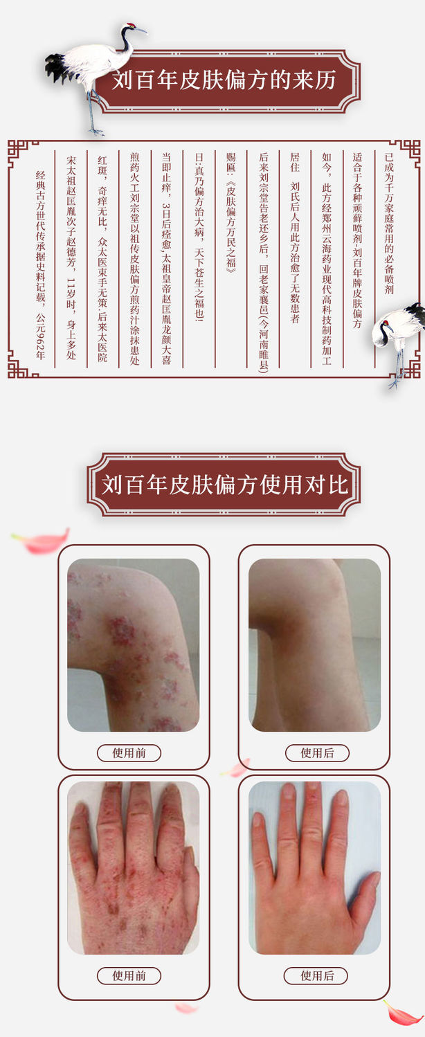 【官方旗舰】刘百年皮肤偏方液止痒干燥起皮痒头皮瘙痒大腿内侧液 一