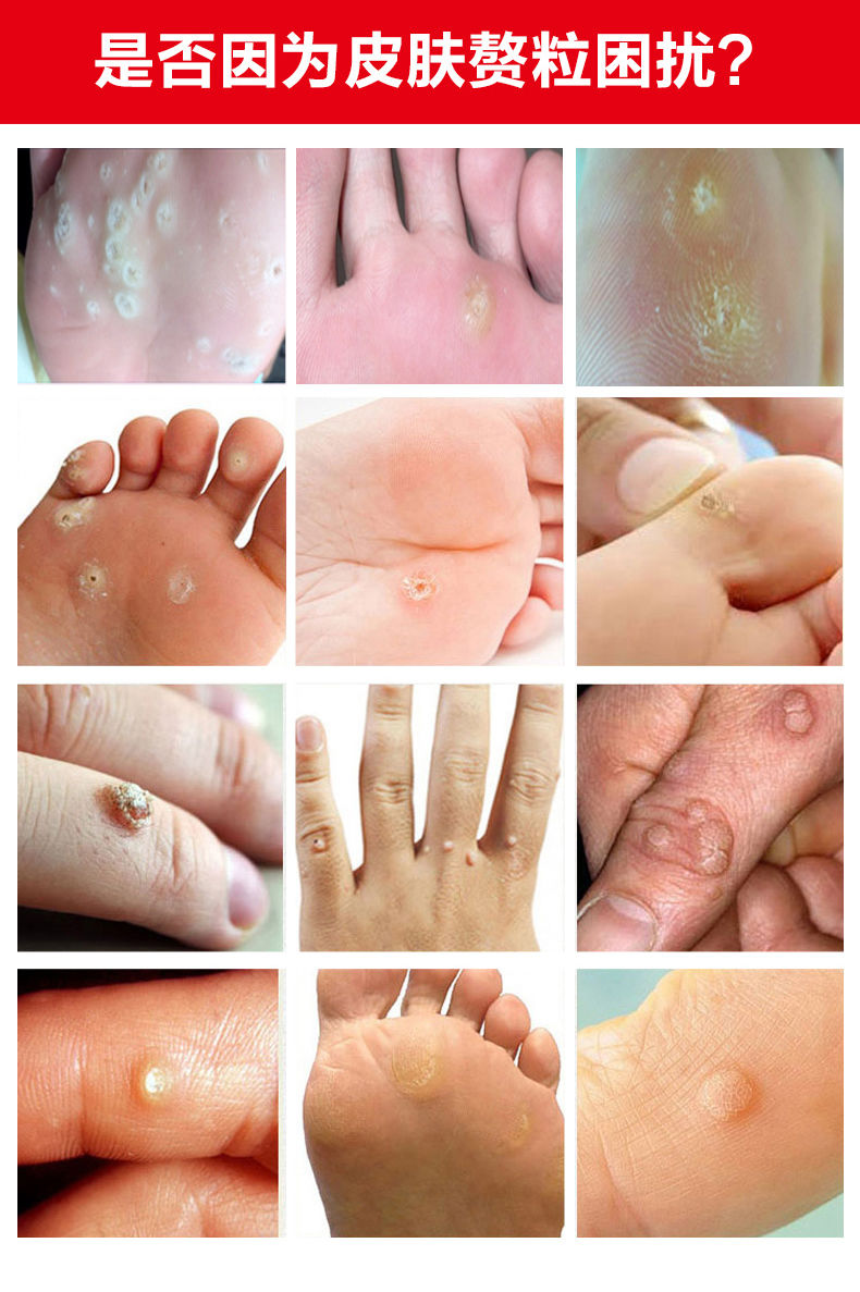 【官方旗舰】膏薬 水猴子 脚趾跖尤脚底手部足部 老茧肉i刺膏 五盒两