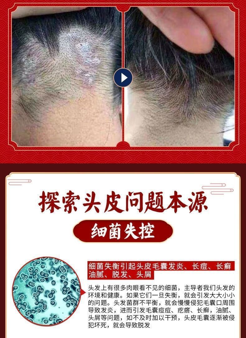毛囊炎克星头部毛囊炎头上毛囊炎头痒头皮屑头皮毛囊炎背部毛囊炎止痒