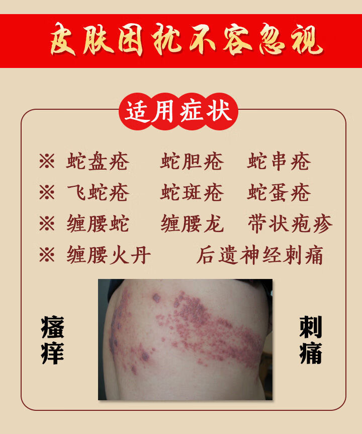 和蛇盘清草本喷蛇盘疮蜘蛛疮带状疱0疹后遗症神经疼痛 疗程装买2 1(发