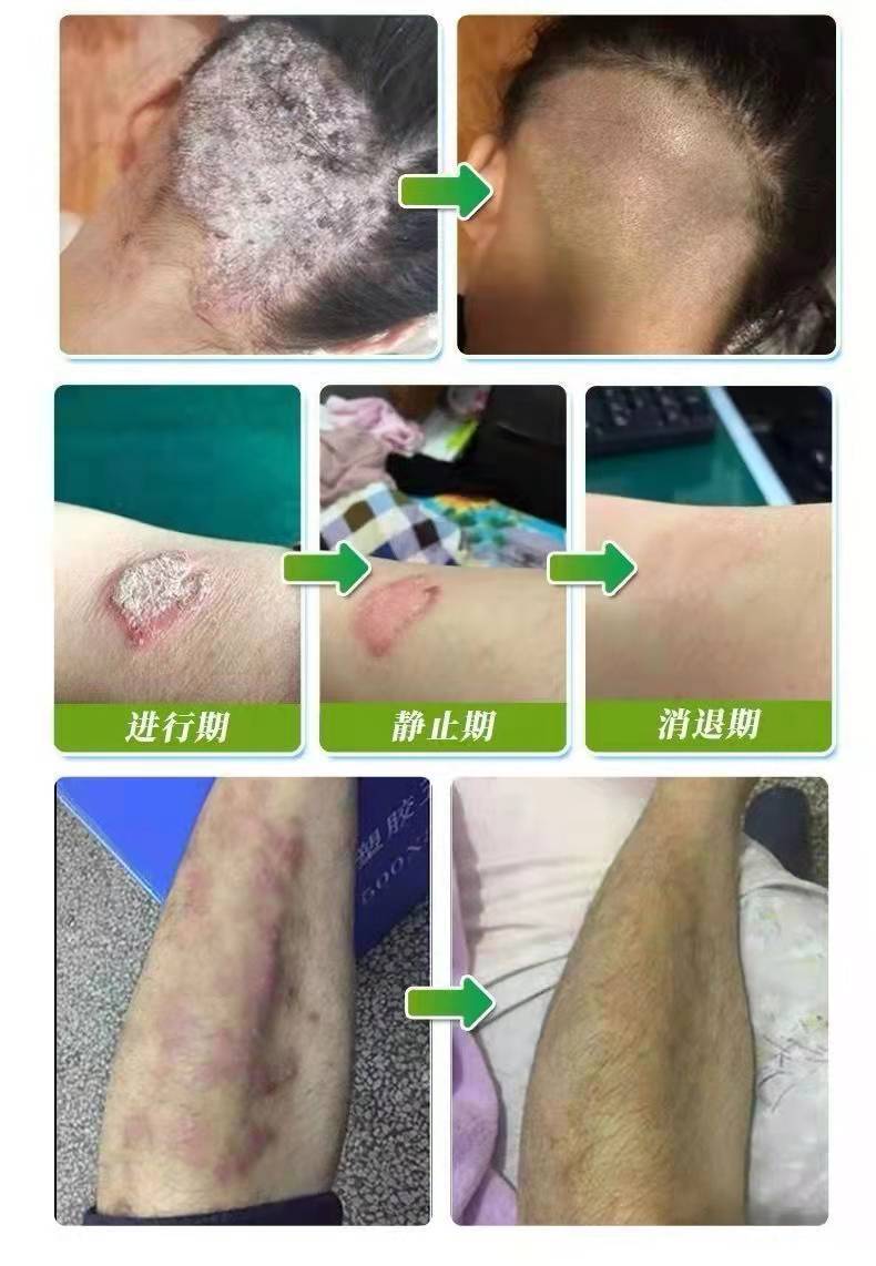 【官方自营】复方黄柏祛l癣搽剂 初肤堂复方黄柏祛l癣搽剂治去l根喷剂