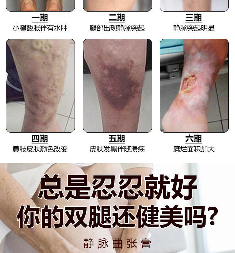 脉疏通静脉曲张蚯蚓腿青筋凸起下肢酸胀老烂腿精索腿部肿胀青筋扩张