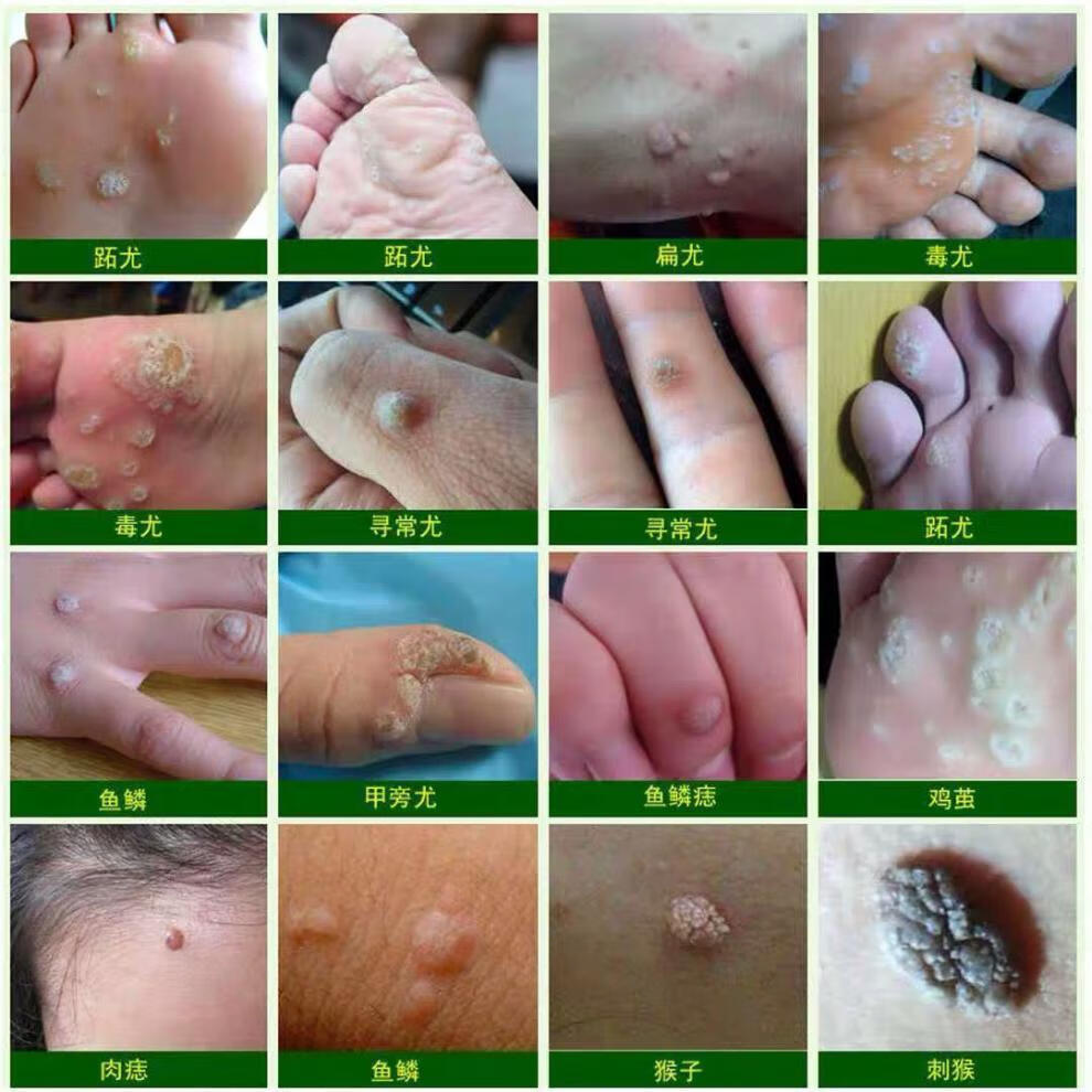 瀚孚泉【官方旗舰】肖神医瘊优偏方正宗特孝膏甲周疣刺猴子 一盒装