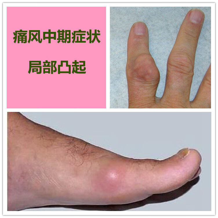 关节肿痛高尿酸症尿酸盐结晶痛风石手指脚趾鼓包家用痛风理疗仪 风湿