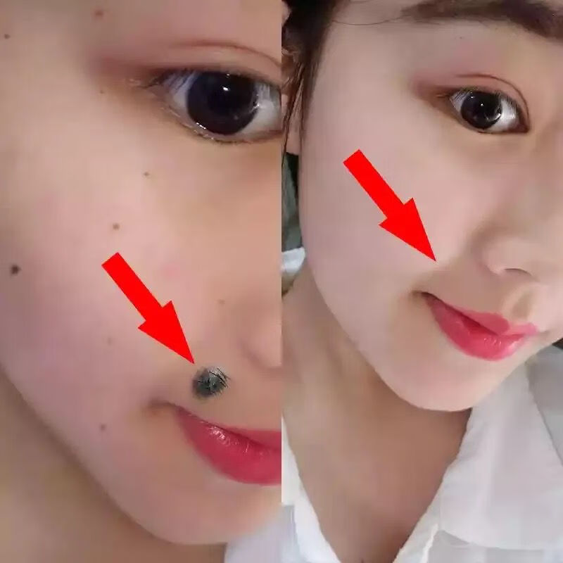 去除脸上的黑点去脸上黑点痦子斑点黑志老年斑君桐脸部雀斑痣水去除蒙