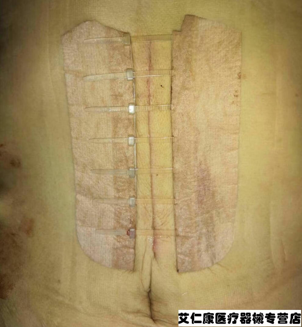 皮肤减张器 皮肤减张器九院立辰医用皮肤表面缝合器伤口减张器疤痕