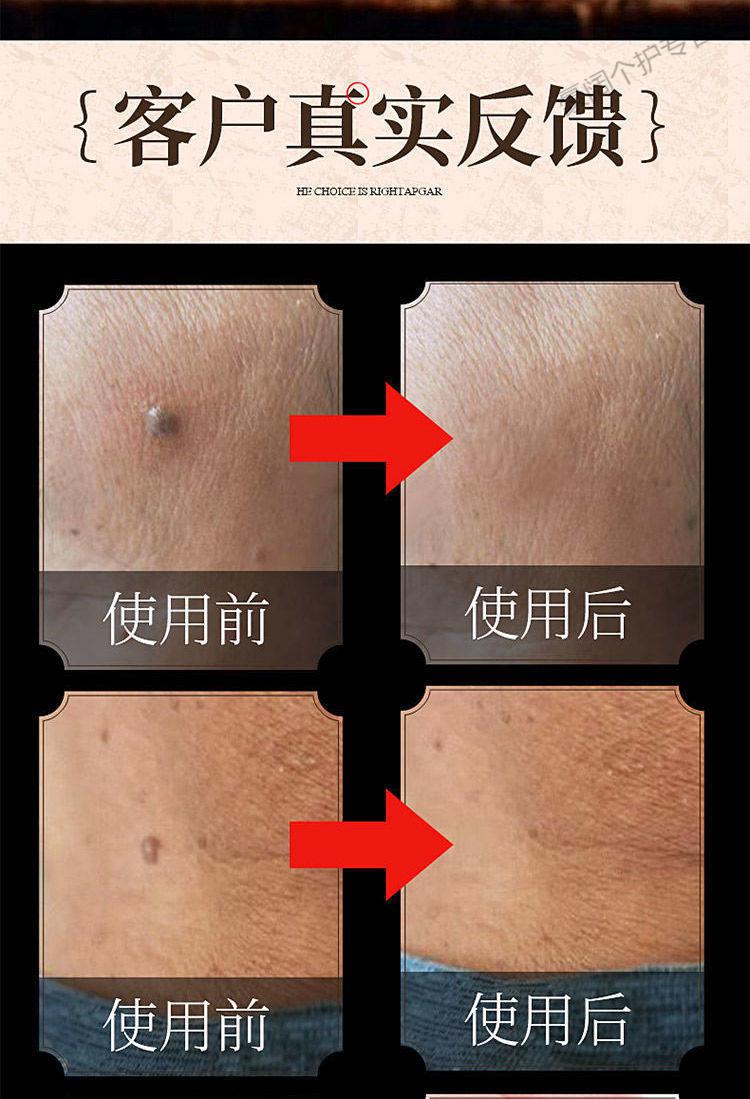 日本原料去l肉粒鸡眼扁平尤猴子疙瘩去除脖子赘肉特孝膏无痛不留疤