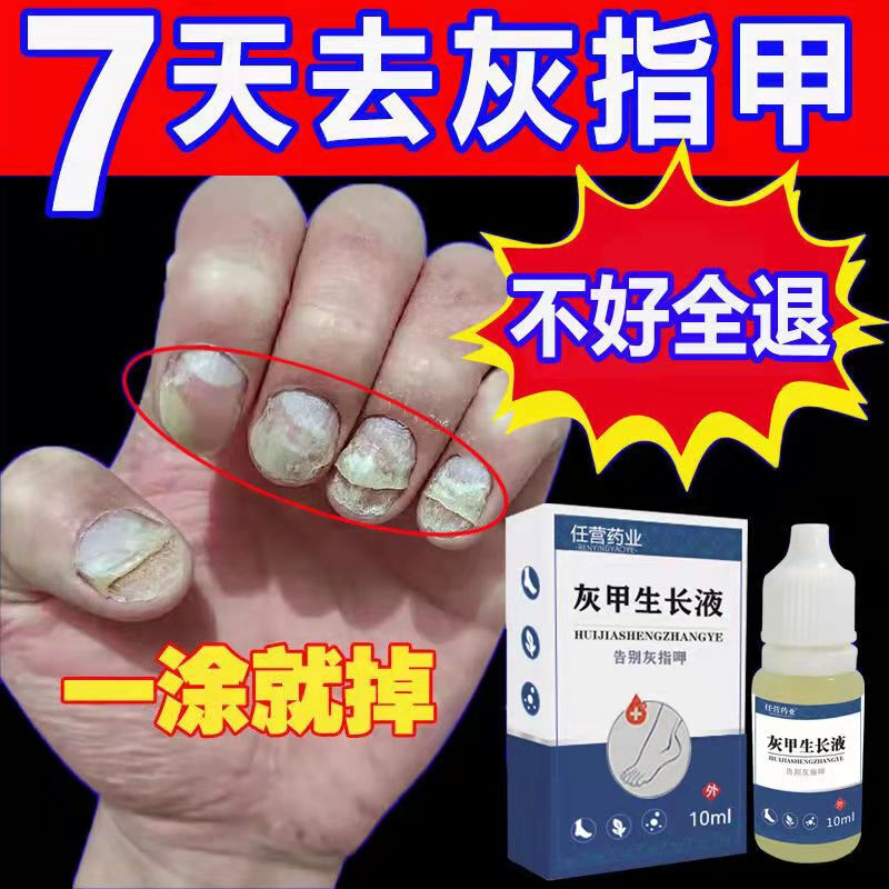 乐宁清灰指甲指甲恢复液拯救顽固灰甲指甲甲板分离直接发白厚甲指甲