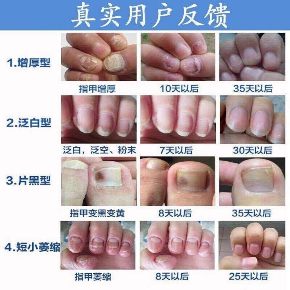 方教授灰甲清液一瓶5ml灰指净甲用6天不用包渗透