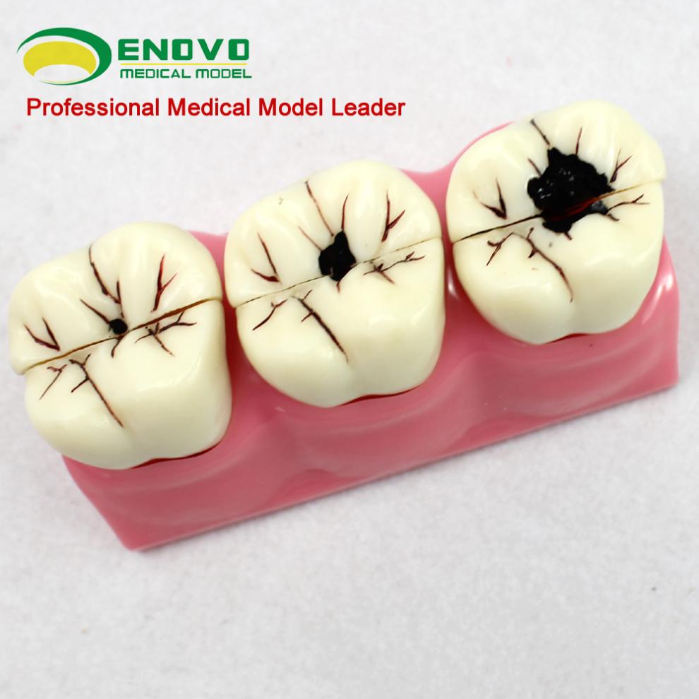 enovo颐诺口腔科牙齿龋齿分解模型儿童蛀牙模型口腔健康演示口腔病理