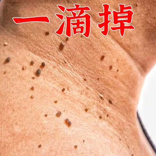 Remove small pimples on the neck, monkey black spots, filamentous thorns, plantar tags, remove flat tags, regular skin tags under the armpits
