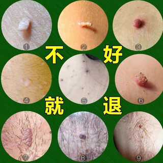Xinlang plana warts, filiform warts, common warts, neck and armpit fleshy balls, can be removed in one go without leaving any trace on the same day, cream color 5.m