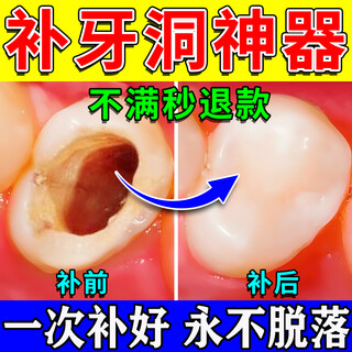 Artifact for filling teeth at home. the resin material is used to fill gaps between teeth. it can repair 10 teeth in a box.