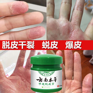 Yunnan materia medica hand and foot peeling antibacterial cream seasonal hand peeling finger palms sloughing, cracking, cracking, skin blistering fungal infection hand and foot peeling cream 20g one bottle sent 1 bottle/box
