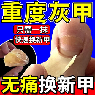 The no. 1 onychomycosis effective medicine in hong kong pharmacy, nail groove thickening, nail cavity fungal infection, nail removal and nail polish impatiens care solution, 1-2 onychomycosis in a box