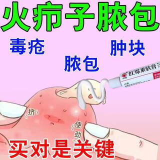 Fire boil ointment for pimples on the back of the neck, white hard lumps, pustules, redness and pus, gas pimples, acne, hard fat lumps, cysts, sores, small area burns, skin disease medicine, erythromycin ointment 1 box