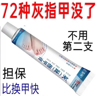 Severe onychomycosis, toenail thickening, yellowing and shrinkage, nail polish, antibacterial ointment, topical artifact 699+ moderate