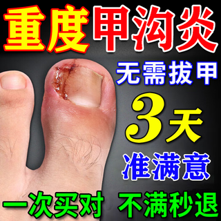 Hahiro iwai specializes in paronychia removal and cures toenail growth, reduces swelling and pain, removes granulations and treats severe polyps. paronychia ointment. one box/20g. specializes in paronychia. paronychia external anti-inflammatory ointment.
