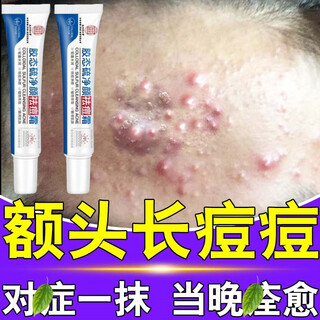 Nanjing tongrentang acne removal plaster for male and female students, teenagers with long forehead acne, closed acne removal, genuine single box, trial pack, nanjing tongrentang