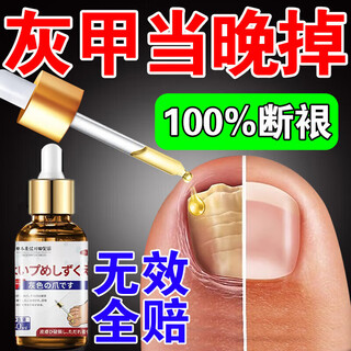 Higashikawada onychomycosis fungal infection removal, thickened nails, thickened nails, bacteriostatic 100% special potion, bactericidal liquid, nail polish, special effects, 1 box, effective that night