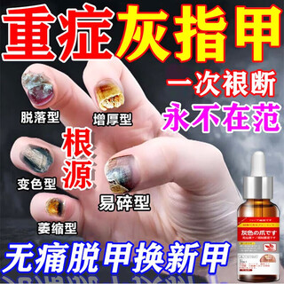 Special effects on onychomycosis. nail thickening, yellowing, thickening and emptying. fungal infection. imported from japan. buy 2 shots of 3. 99w. the patient is fully cured. recommended by doctors. what medicine is good for onychomycosis in jingdong store? quick onychomycosis special large ointment room