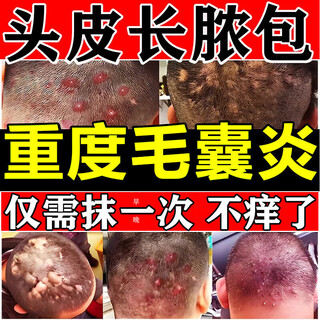 Folliculitis head medicine folliculitis ointment itchy scalp with pimples and redness pimples and pustules on the head scalp hair follicle medicine inflammation special new validity period medicine erythromycin ointment 3 boxes no itching anymore highly recommended by patients jingdong pharmacy official flagship store authentic jingdong pharmacy