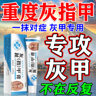 Onychomycosis antiseptic solution no. 1 nail fungal infection removal of bad nails, toenail thickening removal antibacterial potion onychomycosis cream 1 box no. 1 onychomycosis special effect