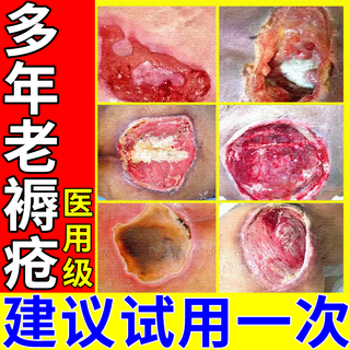 Decubitus ointment boric acid ointment treats pressure sores, pus, and ulcers, promotes healing, removes putrefaction, promotes muscle growth, trauma, and suppuration medicine. blisters on old rotten legs and buttocks, long-term bed rest. 1 box. what to do about decubitus ulcers? mild