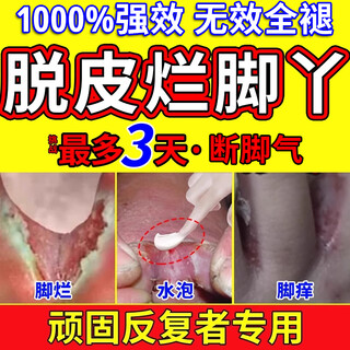 Athlete's foot and odor, 100% special medicine for athlete's foot, antiperspirant, antiperspirant, itching, peeling, rotten feet, fungal infection, 60g, 3 boxes, 100% one-touch deodorization, buy 2 shots of 3